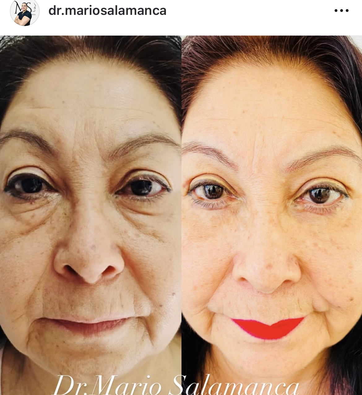 Botox: antes y después
