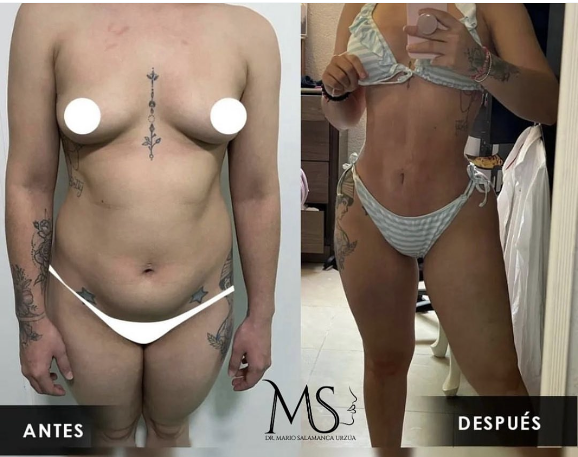 Botox: antes y después