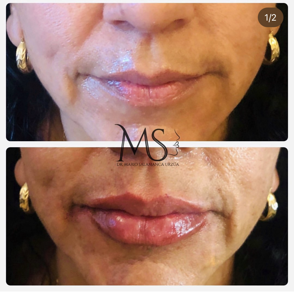 Relleno de labios: antes y después