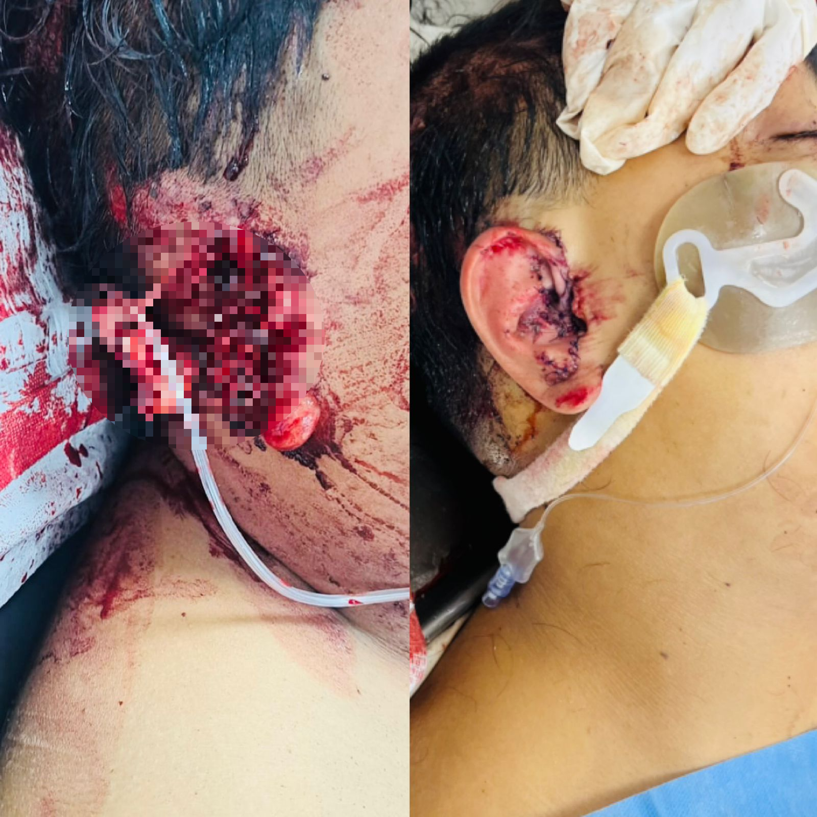 otoplastia reconstructiva