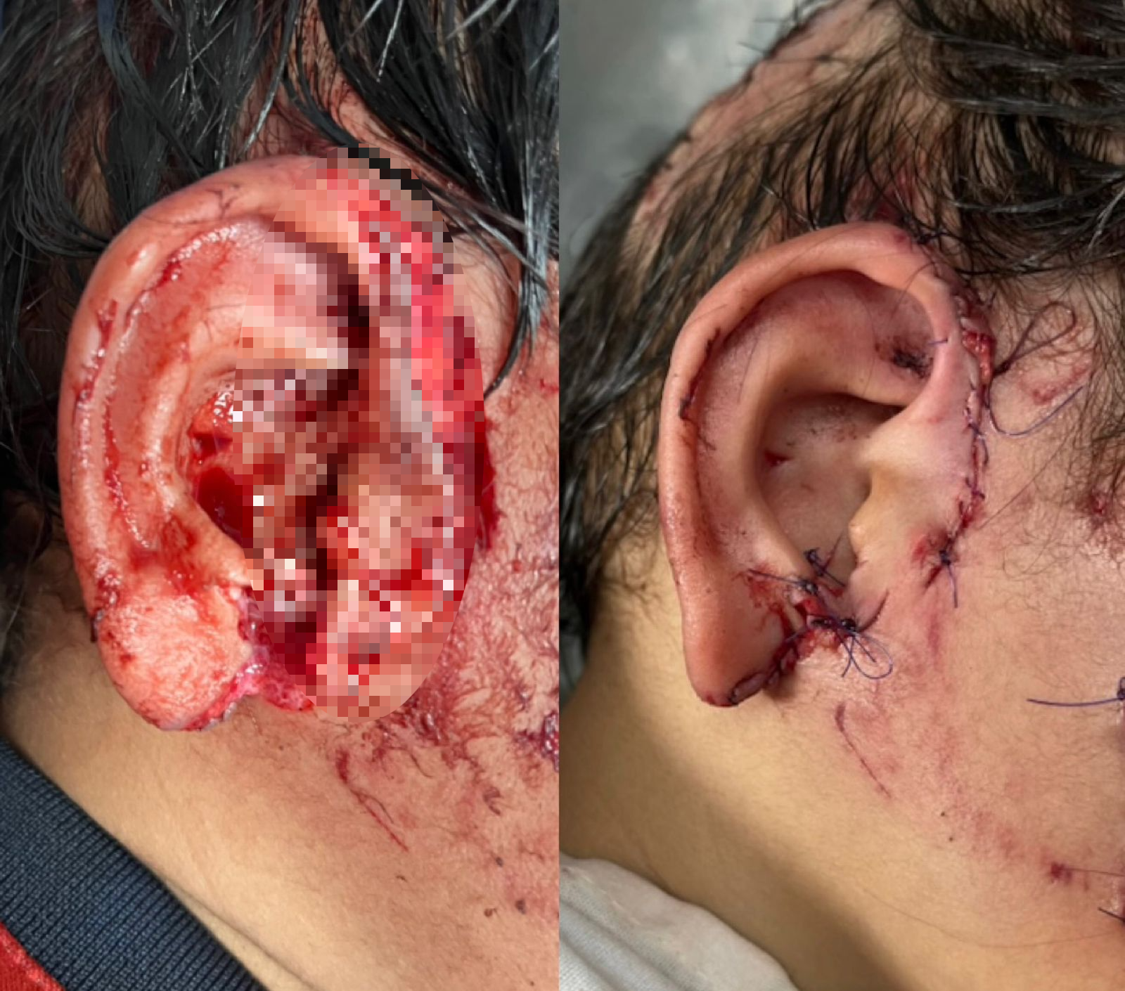 otoplastia reconstructiva