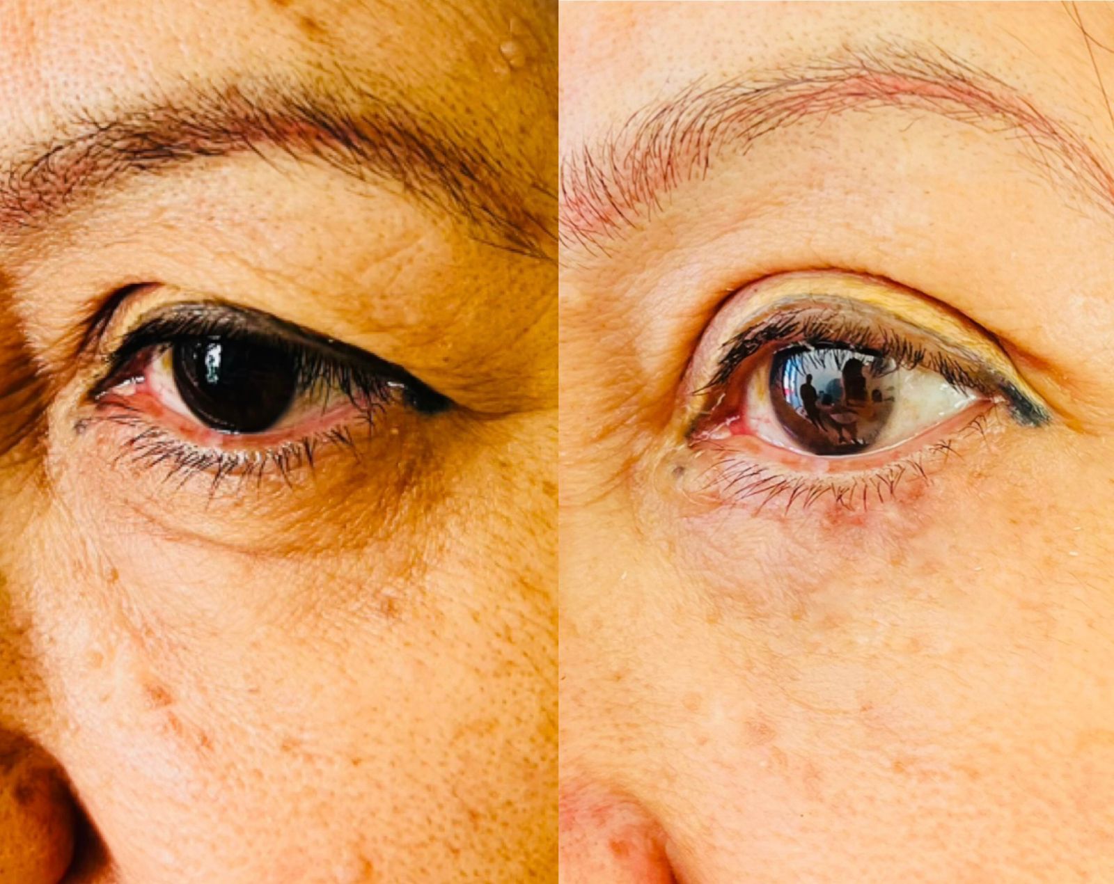 otoplastia reconstructiva