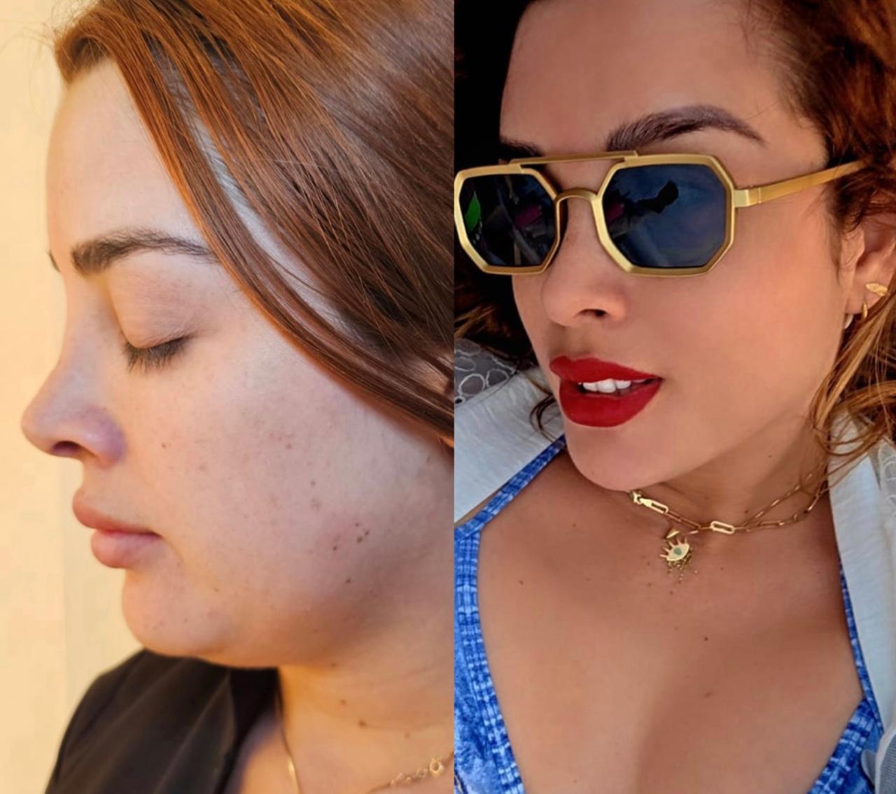 otoplastia reconstructiva