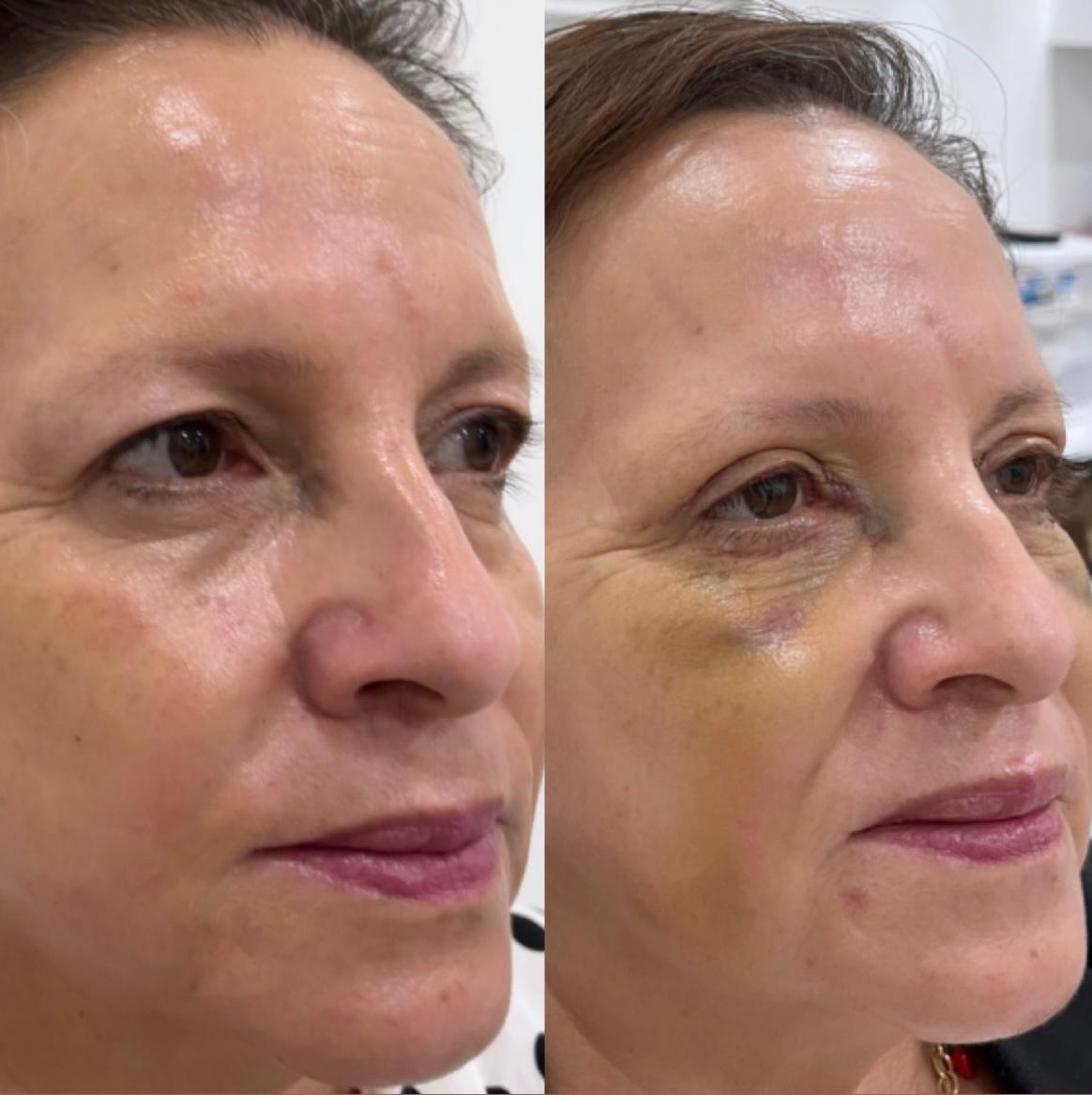 otoplastia reconstructiva