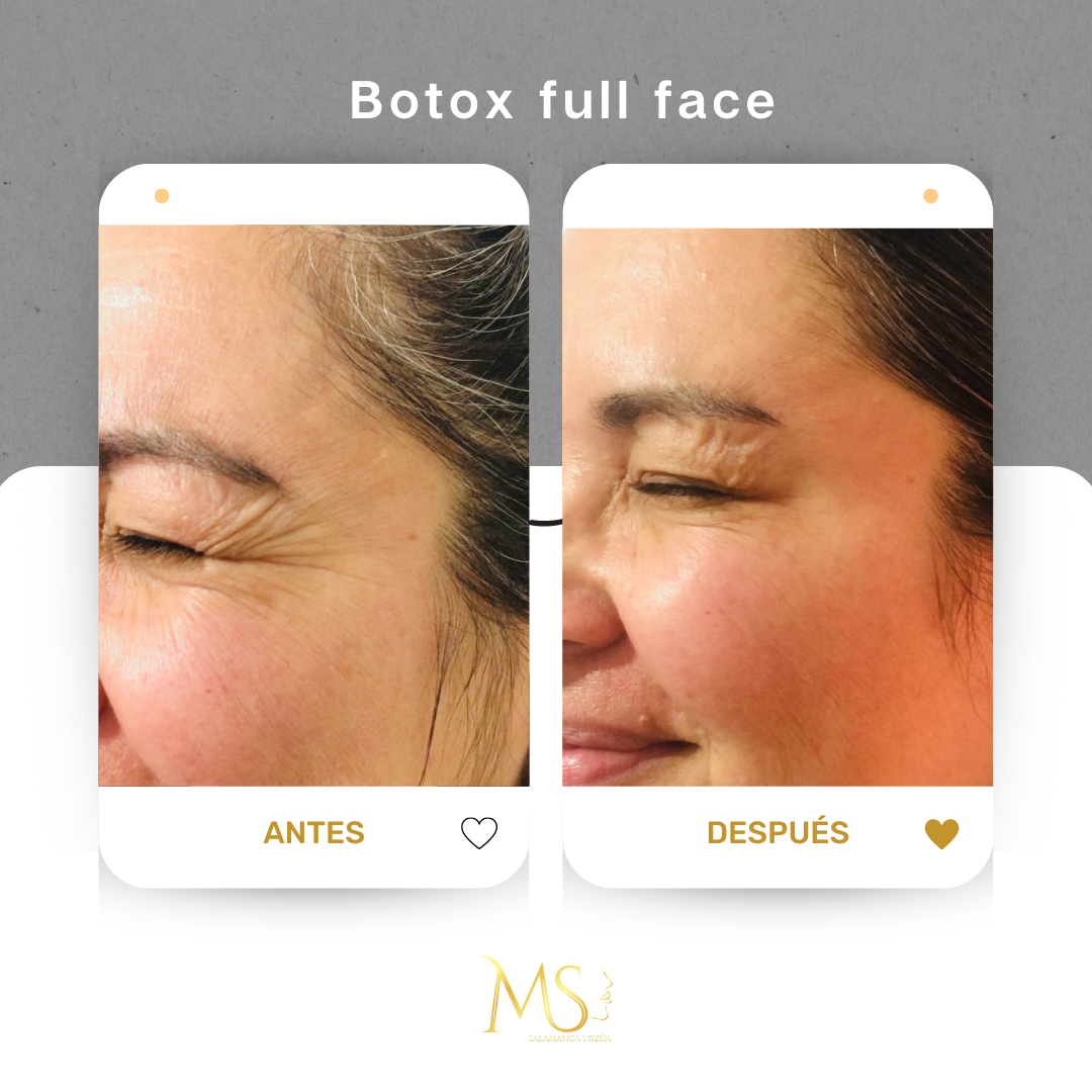 Botox: antes y después
